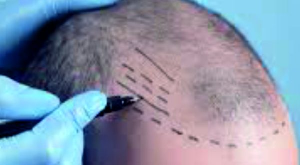 33-Painless Hair Transplant