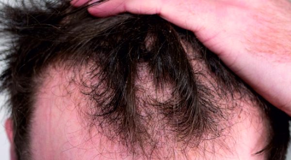 37-Male Hair loss Treatment
