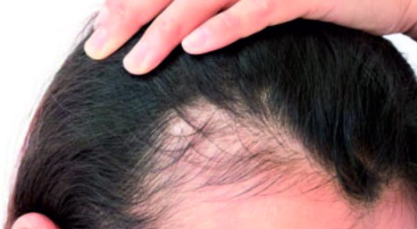 38-Female Hair loss Treatment