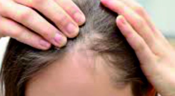 39-Alopecia Areata Treatment