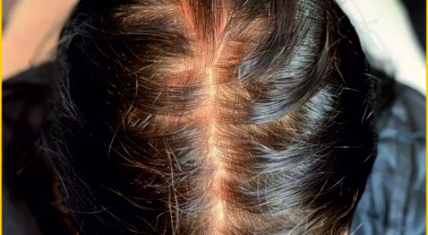 6-Hair Thinning & Anti Dandruff Treatment