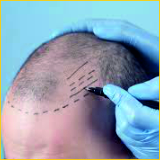 Painless Hair Transplant