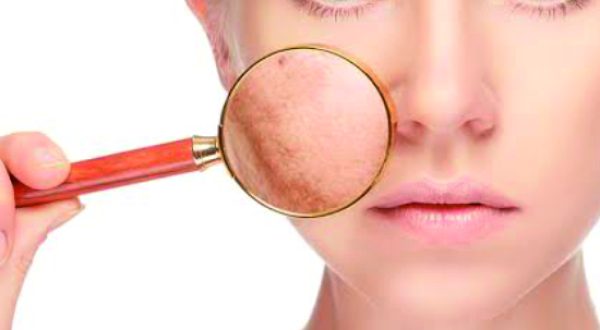 14-Pigmentation, Sun damage, Freckle, Dark Spots, Melasma Treatment