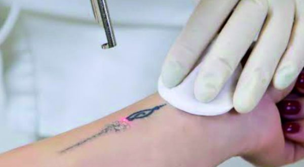 15-Tattoo Removal Treatment