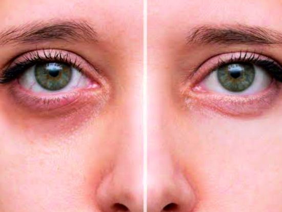 16-Under Eye Dark Circles Treatment
