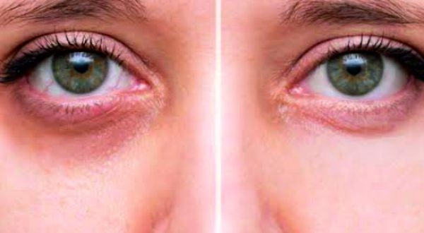 16-Under Eye Dark Circles Treatment