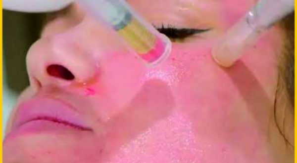 17-Vampire Facial (Red Plasma Facial) Treatment