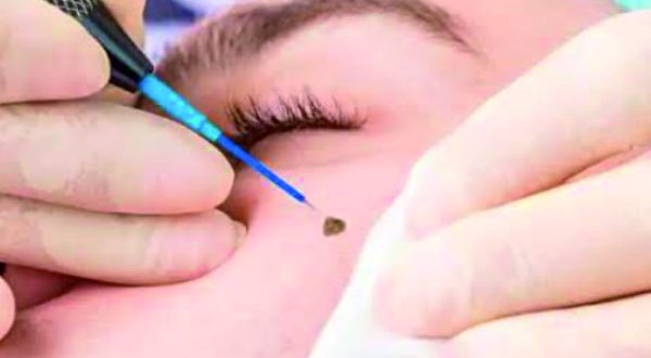 22-Mole, Wart Removal