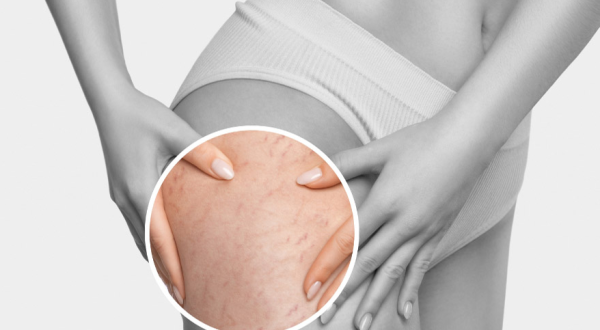 24-Strech Marks Removal Treatment