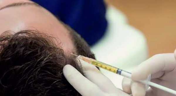 29-I-PRF Hair Regrowth Treatment