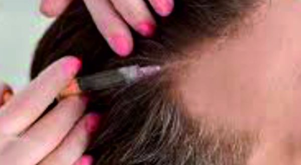 31-Exosome Hair Regrowth Treatment