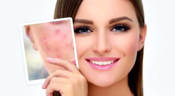 1-Acne, Pimple, Zap, Acne Scars Treatment